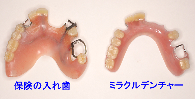 ミラクルデンチャーと保険の入れ歯の比較写真