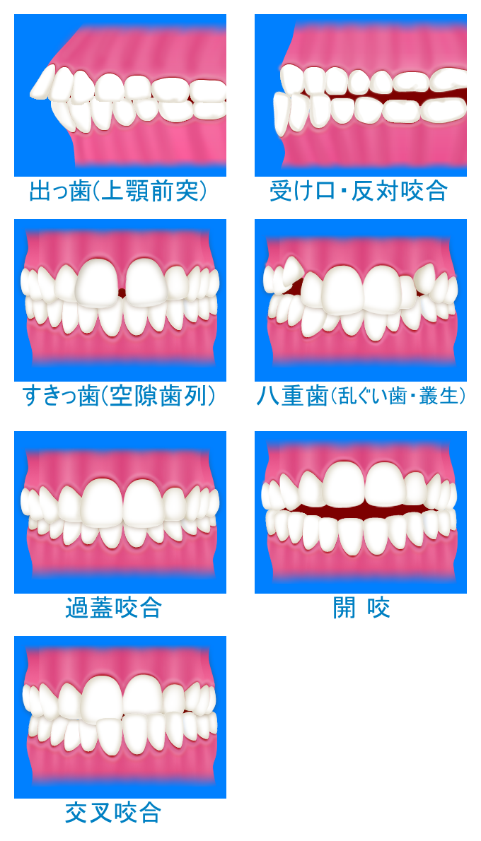 歯科矯正が可能な歯並びのイラスト