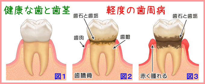 軽度の歯周病の進行状況