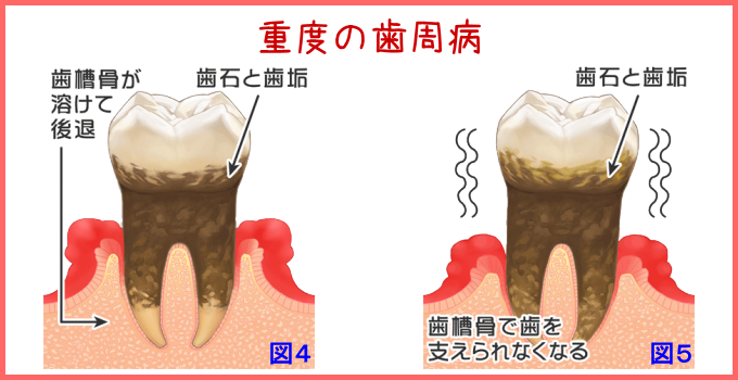 重度の歯周病の進行状況