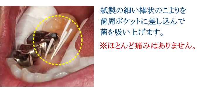 ＰＣＲ検査は紙製の細い棒状のこよりを歯周ポケットに差し込んで菌を吸い上げます。