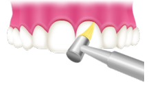 歯と歯の隙間をお掃除のイラスト